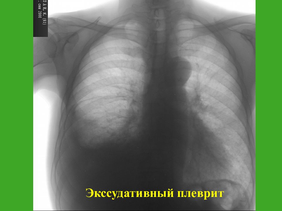 Экссудативный плеврит рентгенологическая картина