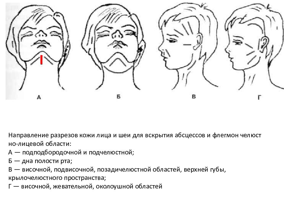 Абсцессы и флегмоны челюстно лицевой области презентация