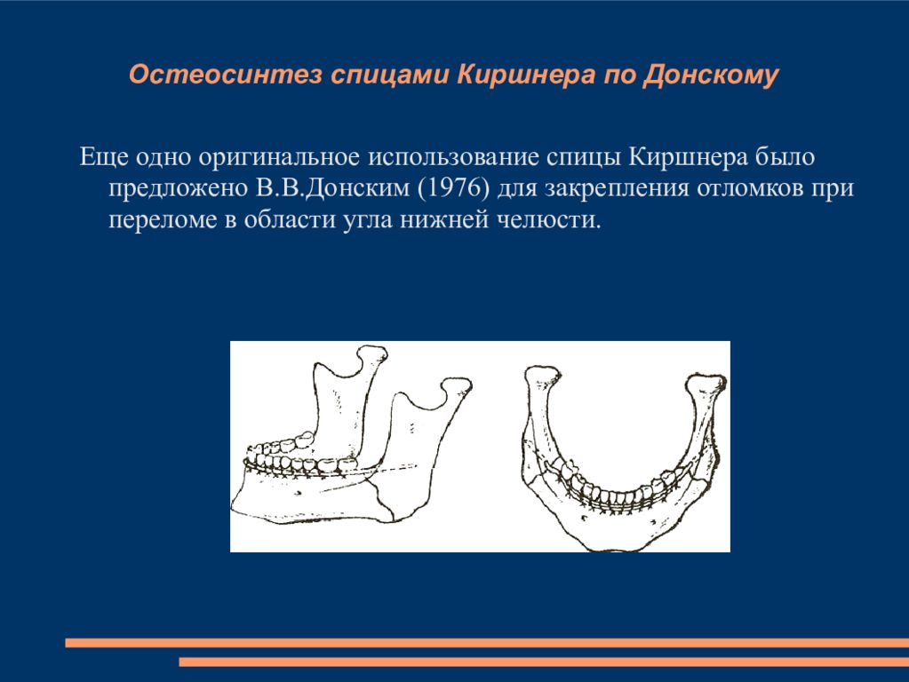 Перелом нижней челюсти клинические рекомендации нмо. Классификация переломов нижней челюсти. Перелом нижней челюсти клинические рекомендации нмо. Ангулярный перелом нижней челюсти. Перелом нижней челюсти клинические рекомендации нмо.