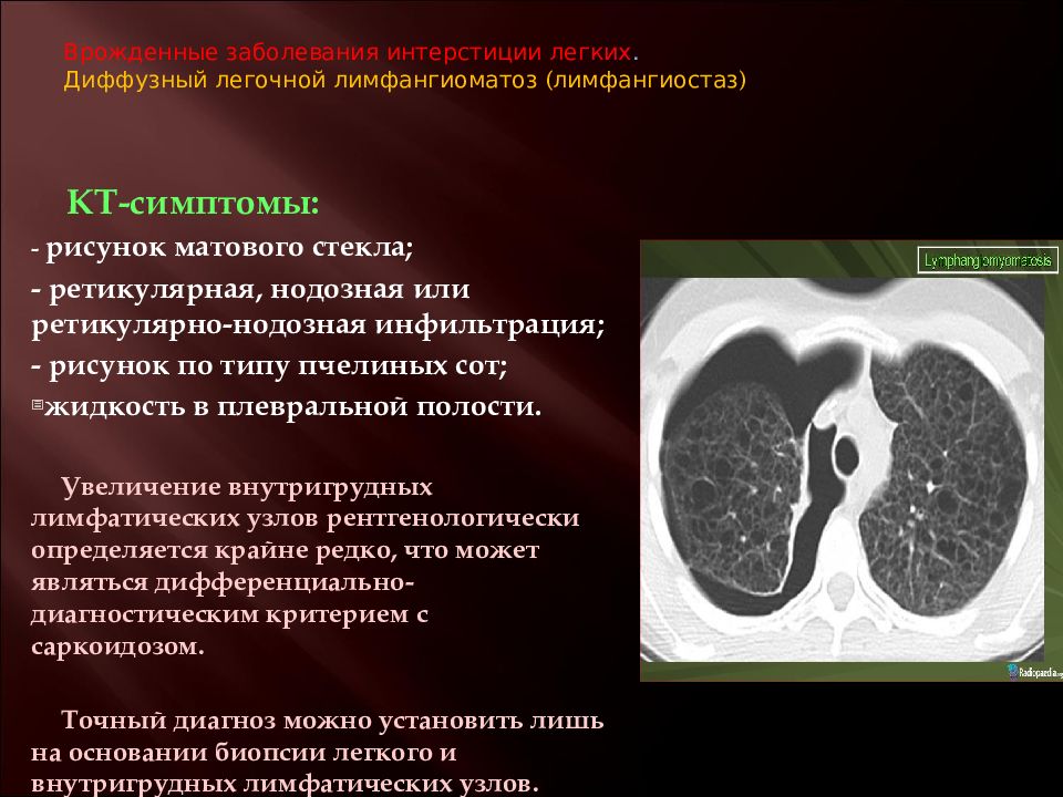 Легочный интерстиций. Аномалии развития легких кт. Легочный интерстиций кт. Врожденные заболевания легких. Пороки развития органов грудной клетки.