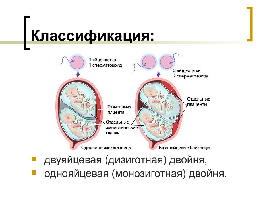 Диамниотическая двойня. Многоплодная беременность разнояйцевые Близнецы. Плацентация многоплодная беременность. Классификация многоплодной беременности. Плацентация при многоплодной беременности.