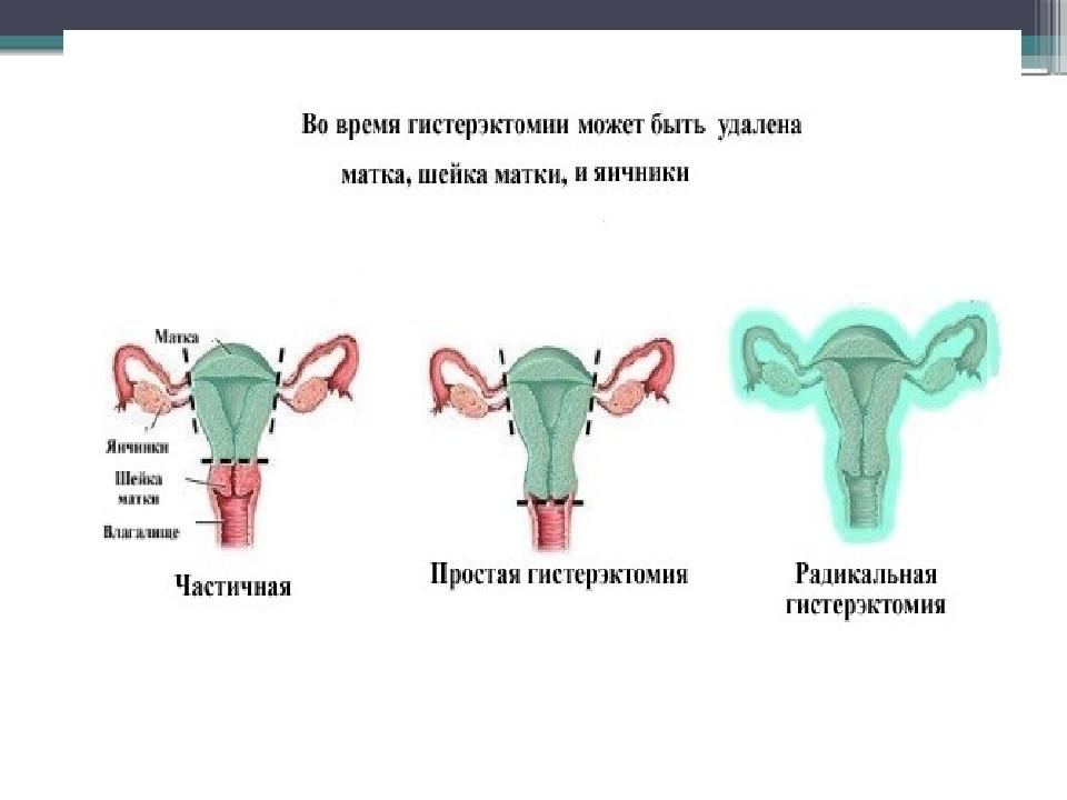 Экстирпация матки