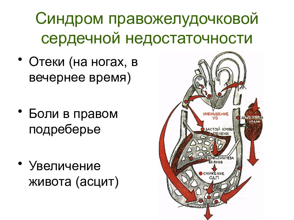 Картина острой правожелудочковой недостаточности