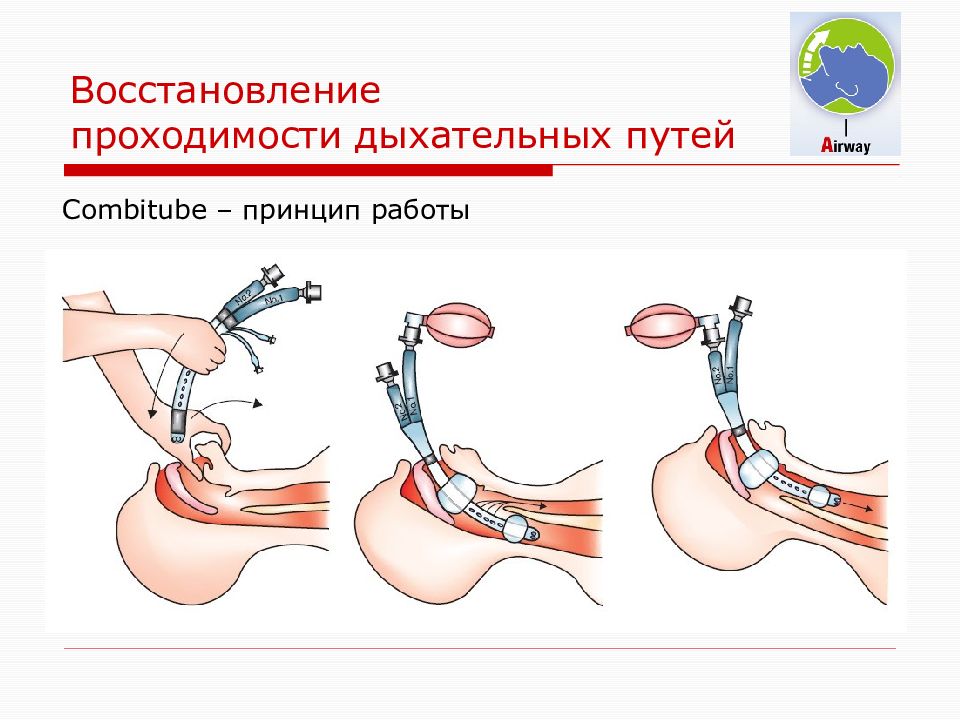 Восстановление дыхательных путей. Восстановление и поддержание проходимости дыхательных путей. Способы восстановления проходимости дыхательных путей. Способы обеспечения проходимости дыхательных путей. Способы восстановления верхних дыхательных путей.