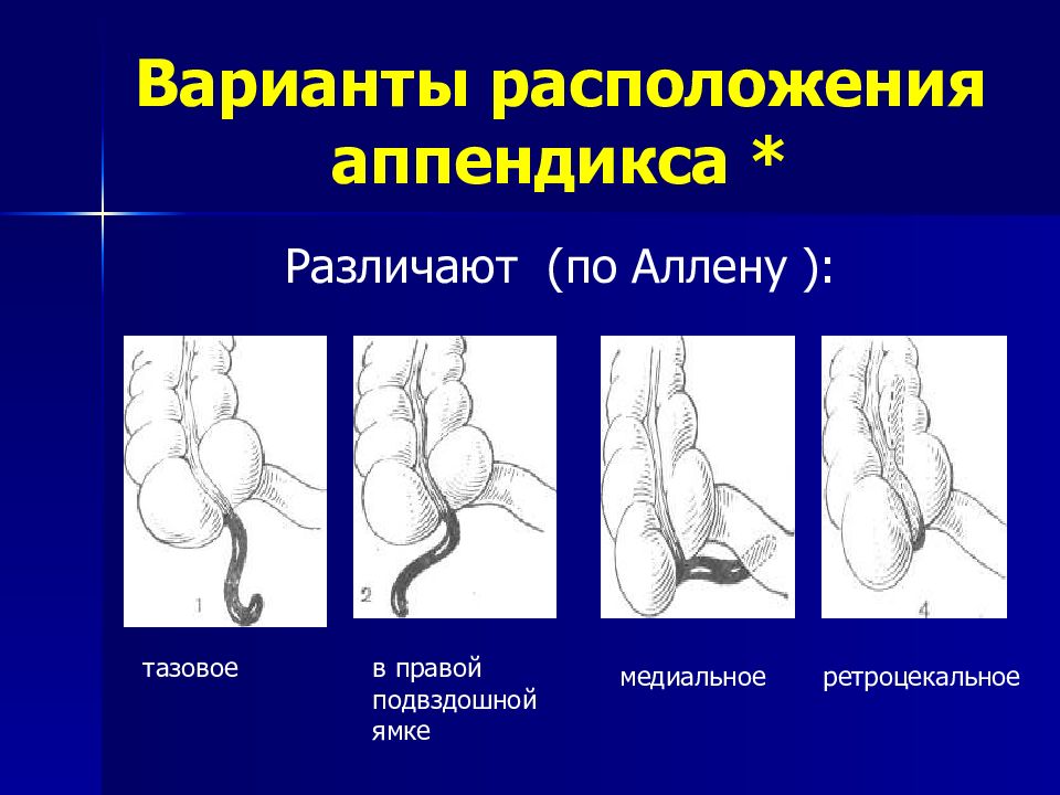 Хронический аппендицит презентация