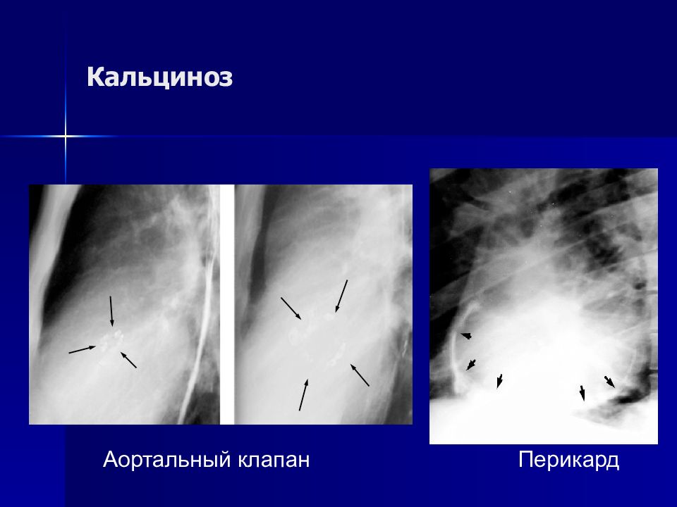 Кальцинаты в стенках аорты