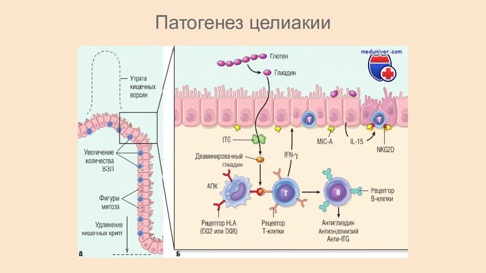 Целиакия презентация педиатрия