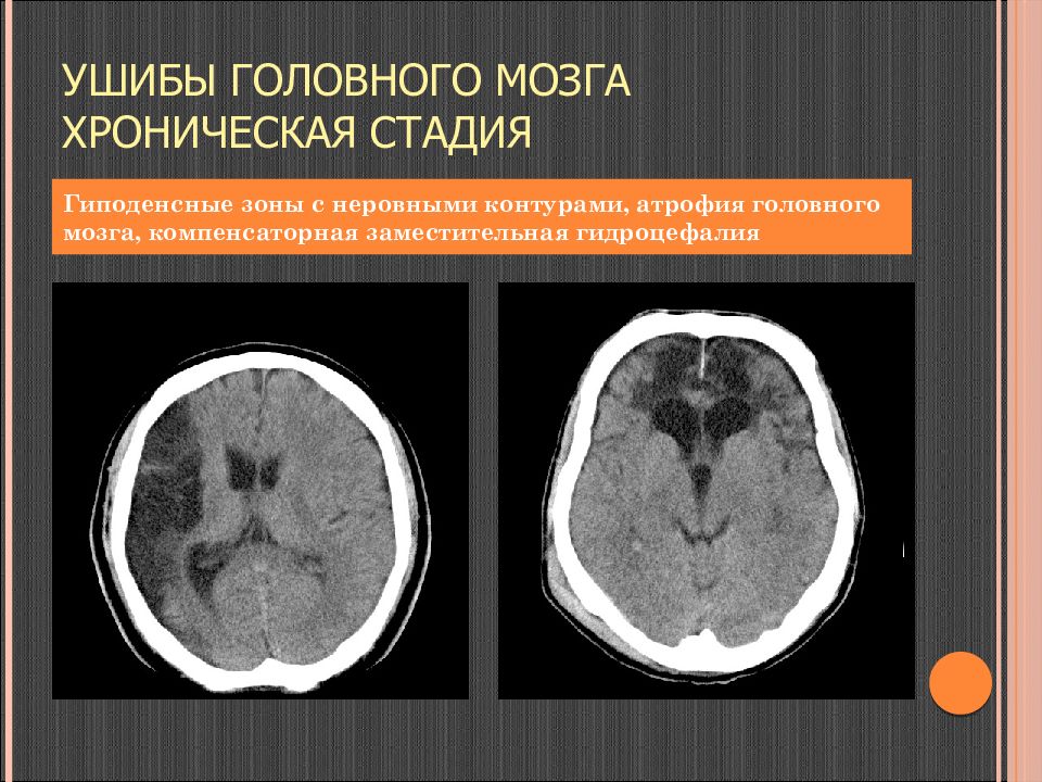 Хронический мозга. Ушиб головного мозга кт картина. Гиперденсивный очаг головного мозга. Гиподенсные очаги головного.