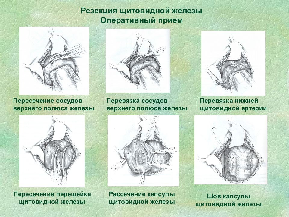 Оперативная и топографическая. Субтотальная резекция щитовидной железы. Субтотальная субфасциальная резекция щитовидной железы. Субтотальная резекция щитовидной железы схема. Резекция щитовидной железы этапы.