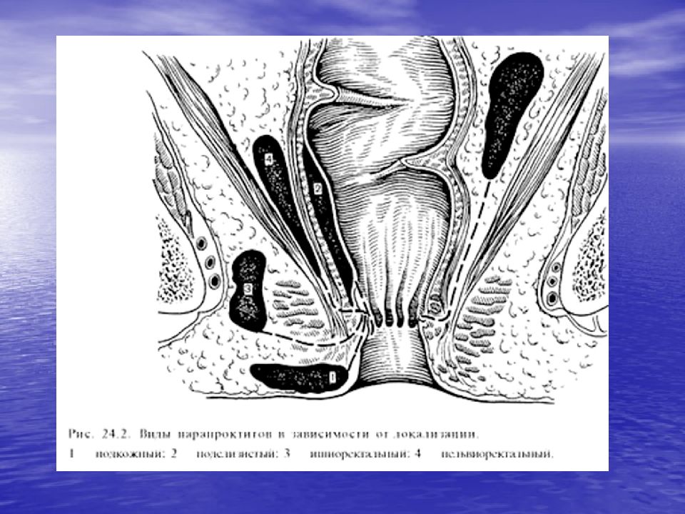 3. Боль и дискомфорт при дефекации