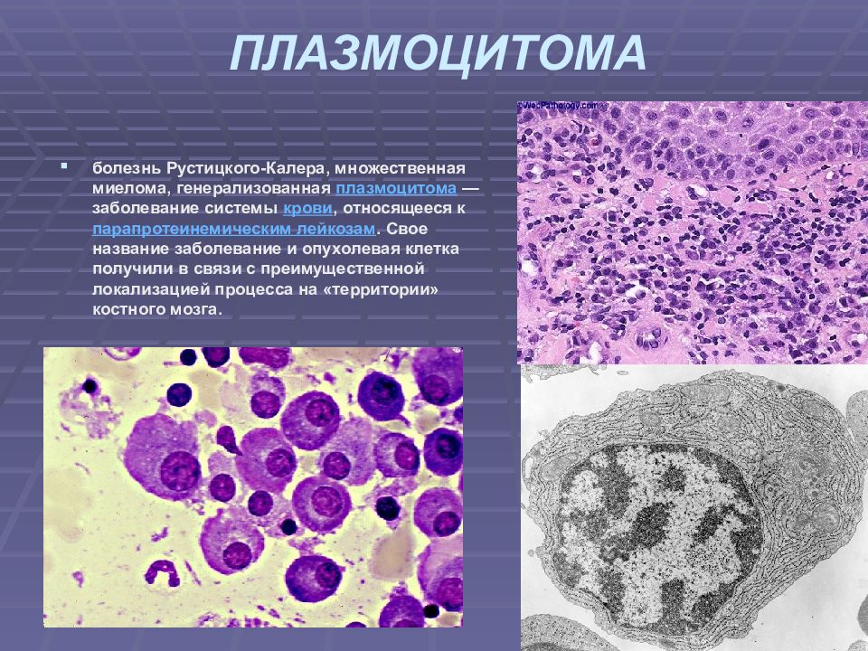 Опухоль костного мозга. Плазматические клетки в костном мозге. Плазмоцитома патанатомия. Плазмоцитома цитология. Миеломная болезнь костный мозг.