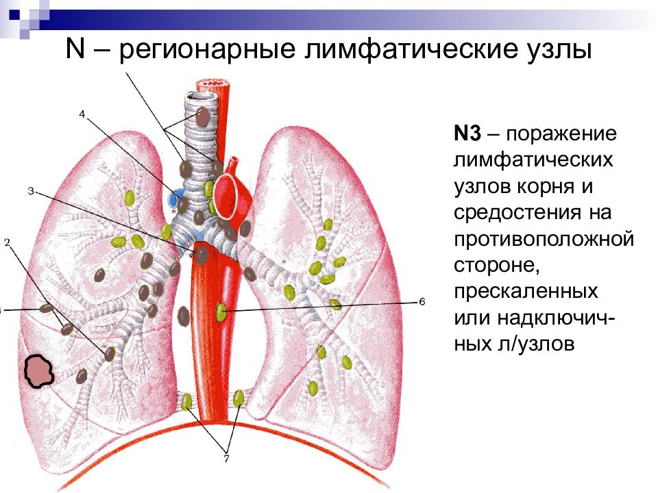 Лимфоузлы легких схема