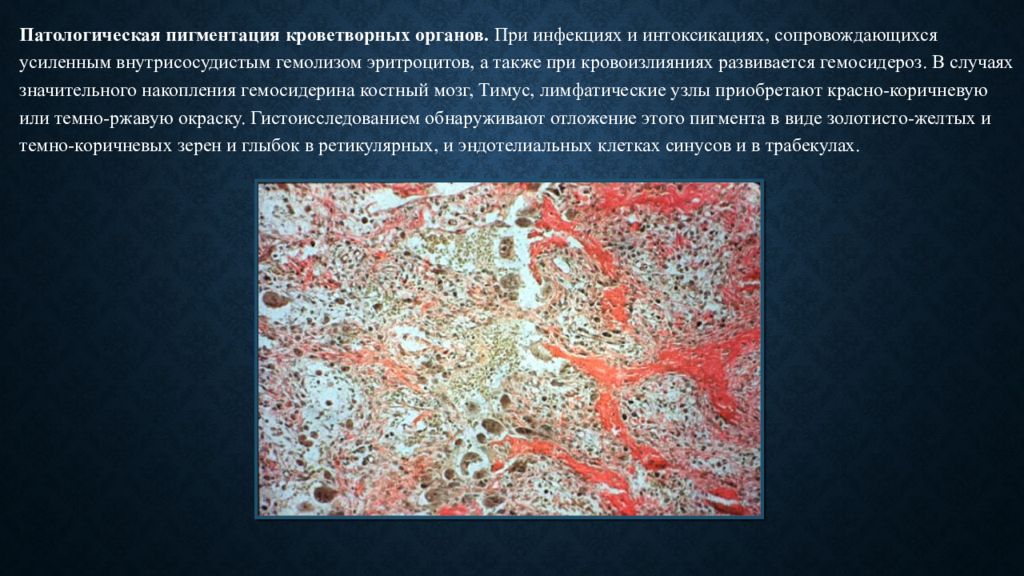 Патологическая анатомия презентации. Гемосидероз печени патанатомия. Гемосидероз патологическая анатомия. Гемосидероз селезенки патанатомия. Гемосидероз печени гистология.