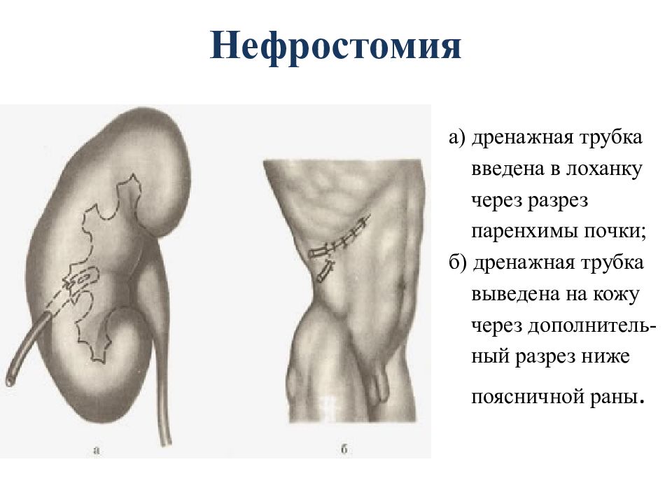 Нефростомия Оперативная хирургия. Нефростомия топографическая анатомия. Нефростомия техника операции. Методы дренирования верхних мочевых путей.