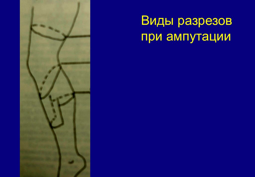 Уровни ампутации нижней конечности. Экзартикуляция нижней конечности. Виды разрезов при ампутации. Ампутация нижней трети бедра.