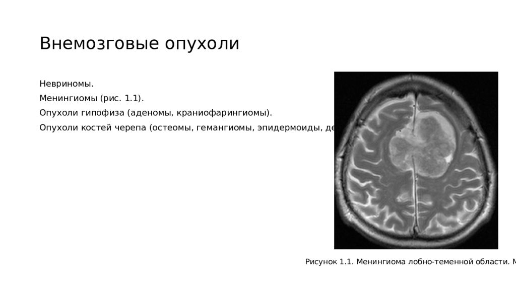 Объемное образования мозга мкб. Внемозговые опухоли ЦНС это. Опухоль лобной доли головного кт. Менингиома лобно-теменной области. Мрт.. Менингиома опухоль нервной системы.