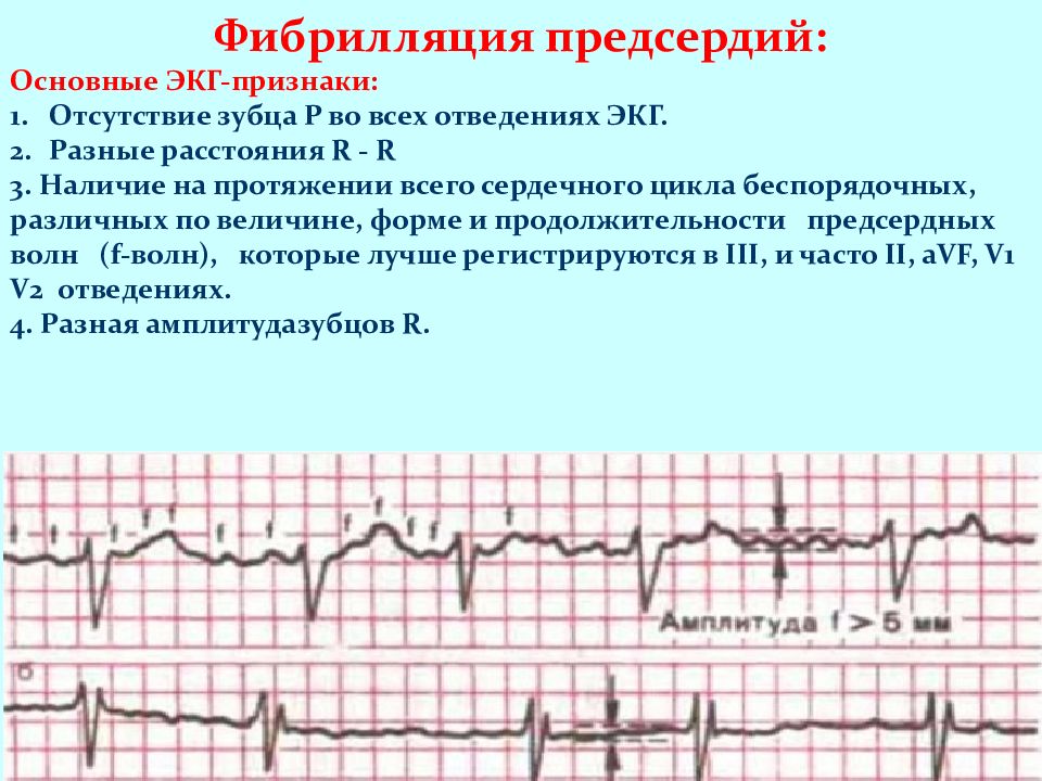 Экг при нарушениях ритма и проводимости презентация