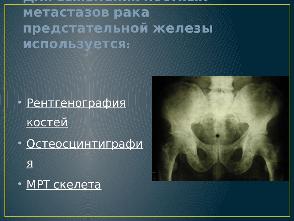 Метастазы предстательной железы рентген. Метастазы в костях Продолжительность жизни. Остеосцинтиграфия; при РПЖ.