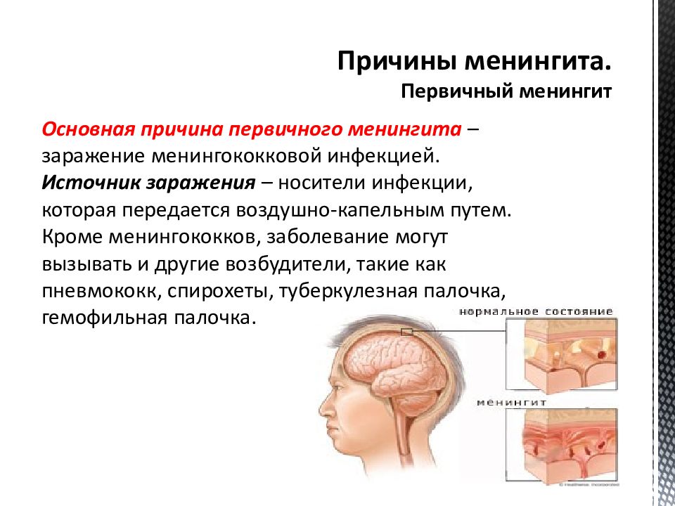 Симптомы менингита у человека