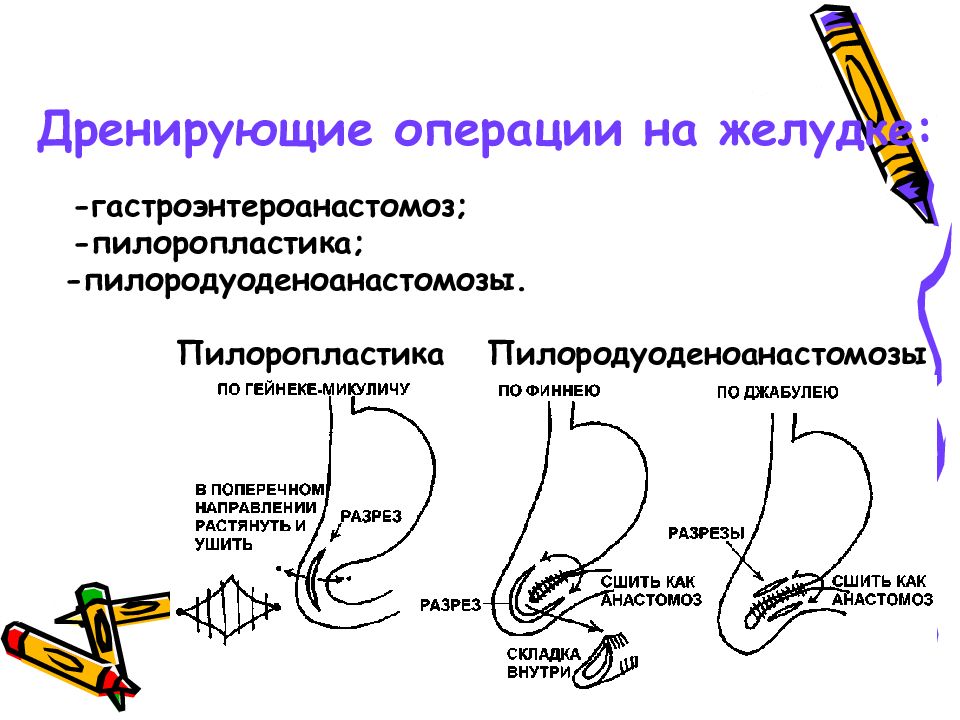 Пилоропластика по финнею схема