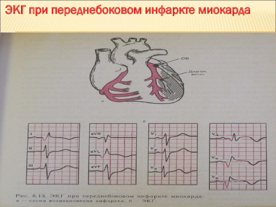 Экг презентация. ЭКГ при переднебоковом инфаркте миокарда.