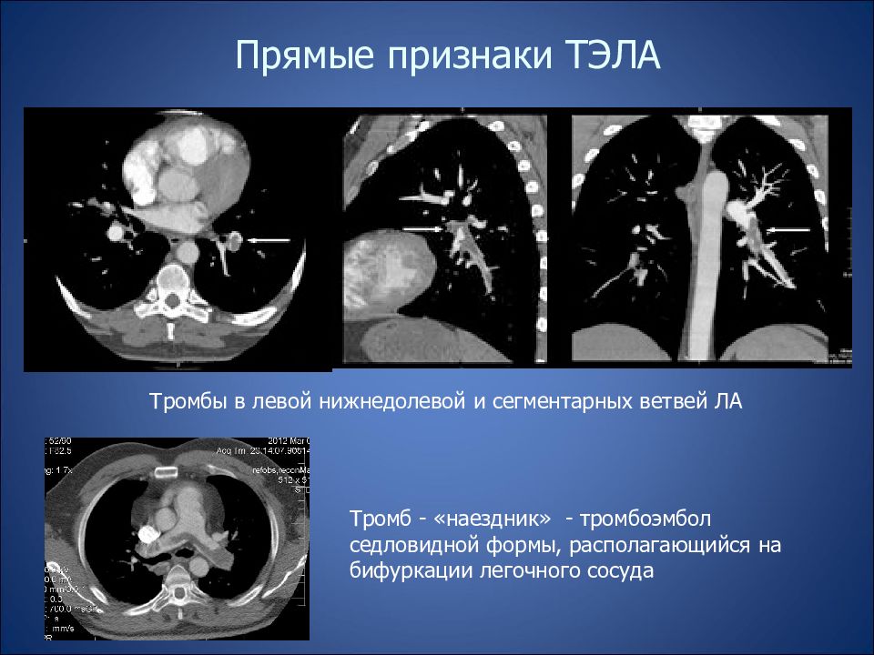 Кт признаки. Тромбоэмболия легочной артерии на кт. Тромбоз легочной артерии на кт.