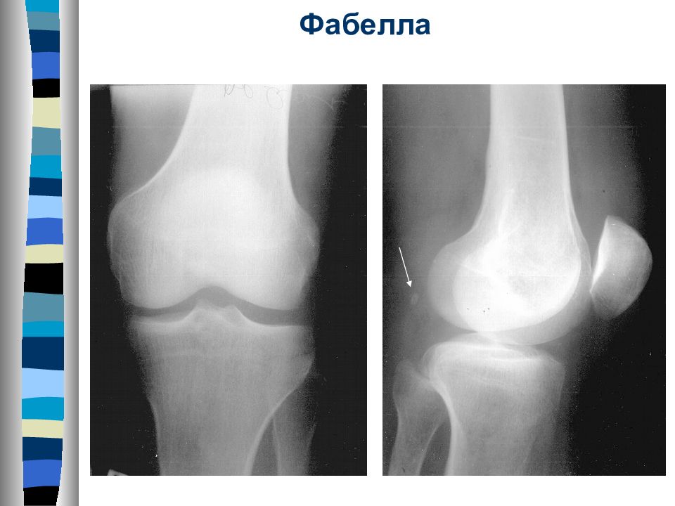 Наследственная остеодистрофия альбрехта презентация