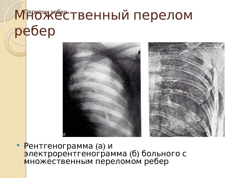 Признаки сломанного ребра. Перелом ребер рентген описание. Перелом ребер рентгенограмма. Множественные переломы.