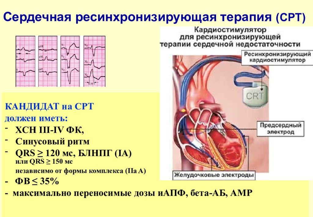 Сердечный комплекс. Ресинхронизирующая терапия ХСН. Ресинхронизирующая терапия сердечной недостаточности. Показания для ресинхронизирующей терапии при ХСН. Ресинхронизирующая электростимуляция желудочков.
