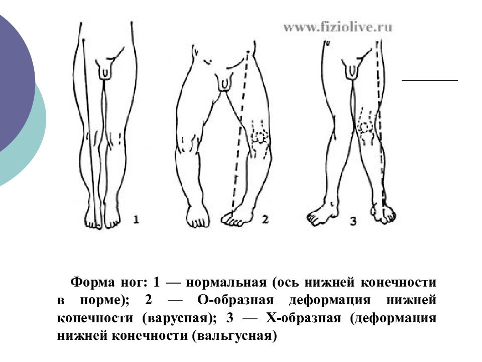 Варусная деформация бедра. Деформация нижних конечностей. Варусная деформация нижних конечностей. О образная деформация нижних конечностей.