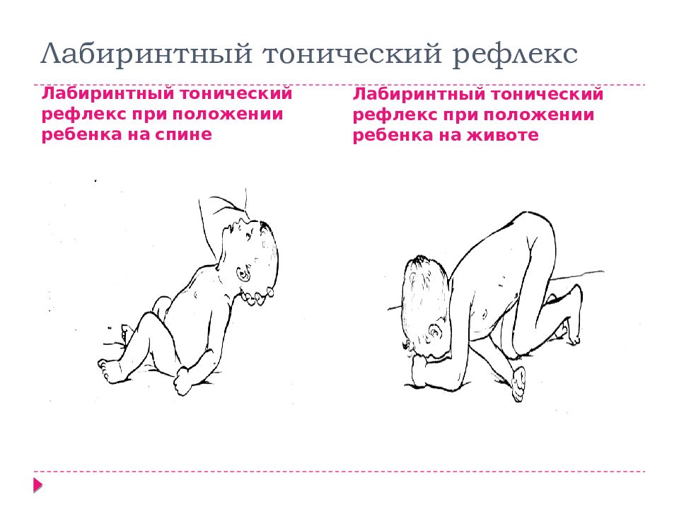 Дцп гиперкинетическая форма презентация