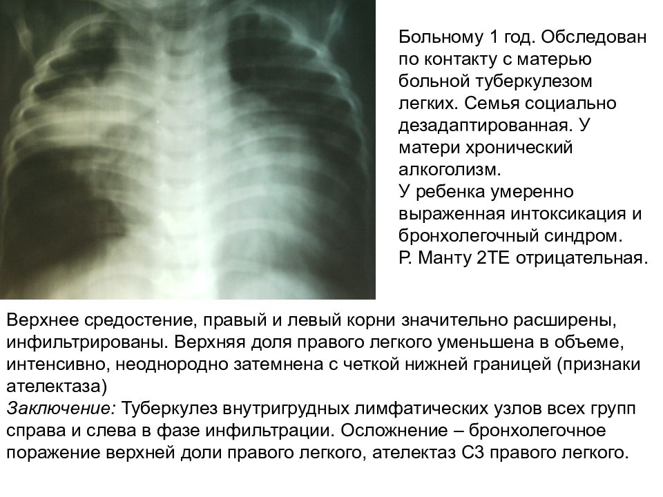 Ателектаз схема легких