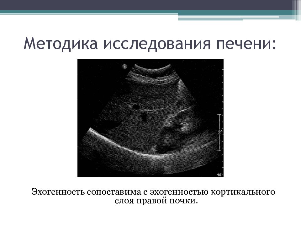 Эхогенность паренхимы. Ультразвуковая диагностика печени. Эхогенность печени. Эхогенность кортикального слоя почки. Методы осмотра печени.