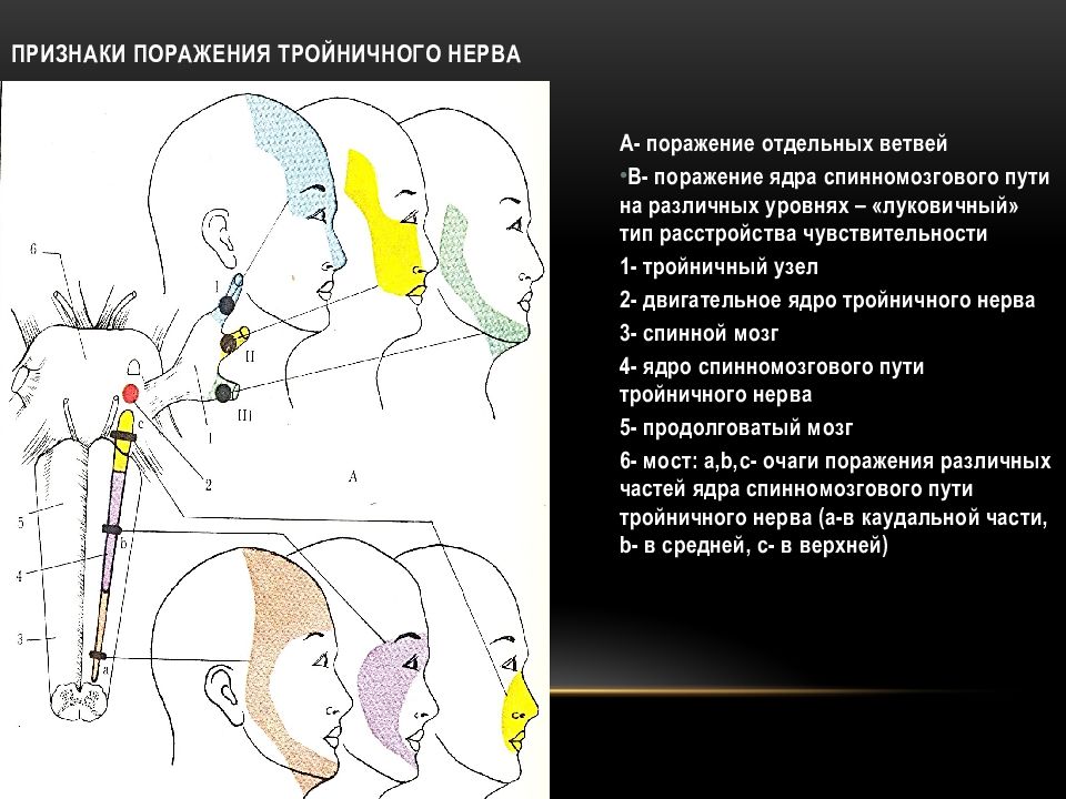 Симптомы поражения черепных нервов. Тройничный нерв мозговой черепно мост. Поражение черепных нервов при инсульте. 5 Пара ЧМН.