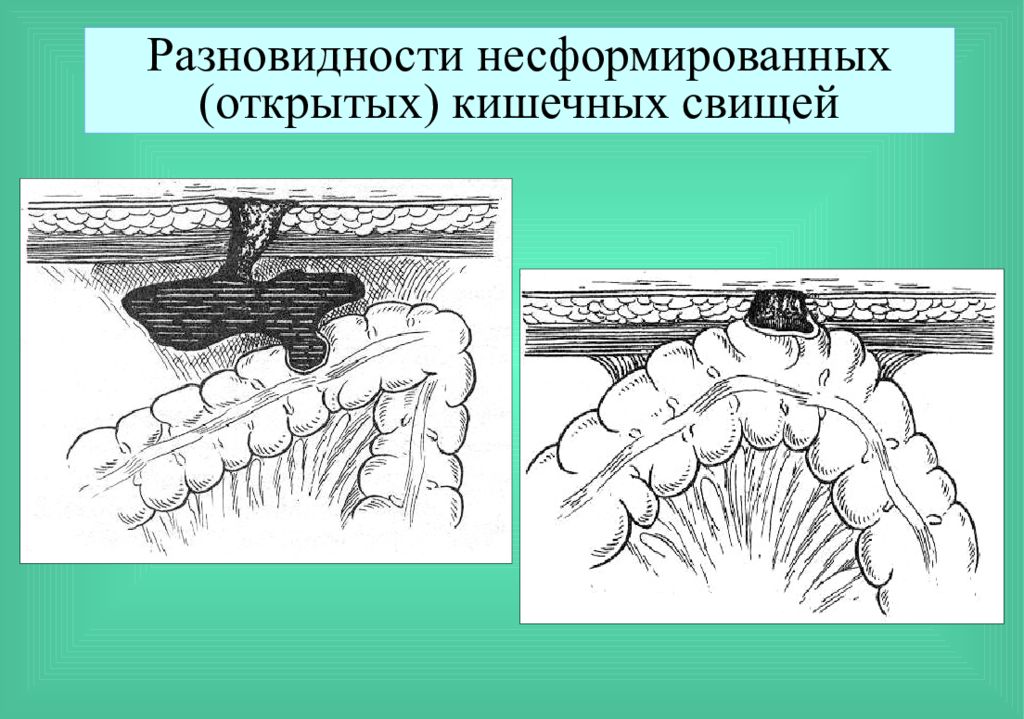 Сформированные свищи. Эпителизированный свищ. Несформированный толстокишечный свищ. Сформированный и несформированный свищ.