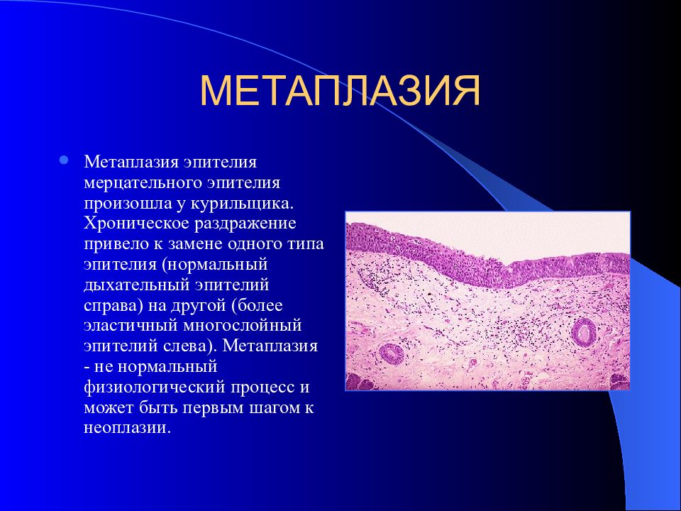 Метаплазия эндометрия. Плоскоклеточная метаплазия эпителия бронха. Метаплазия мерцательного эпителия. Метаплазия призматического эпителия. Клетки метапластического эпителия.