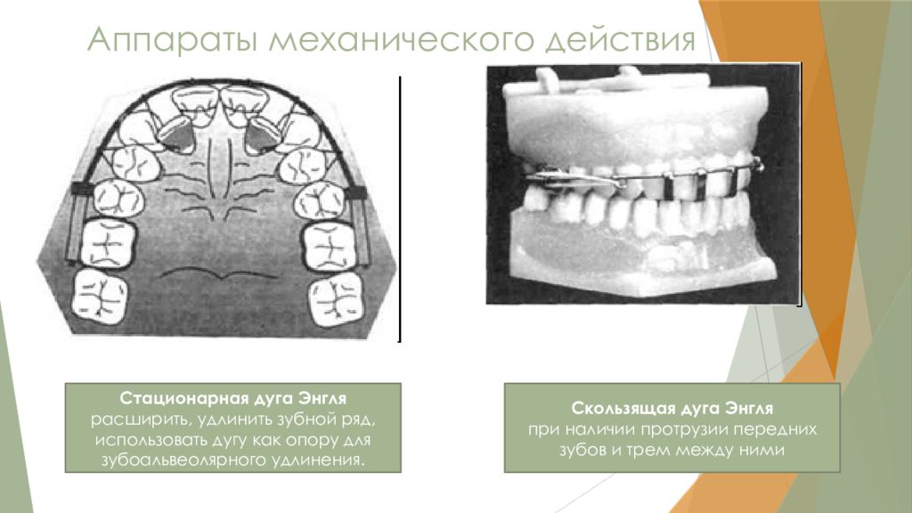 Действия аппарата. Дуга Энгля ортодонтия. Дуговой аппарат Энгля. Пружинная дуга аппарат Энгля. Аппарат Энгля в ортодонтии.