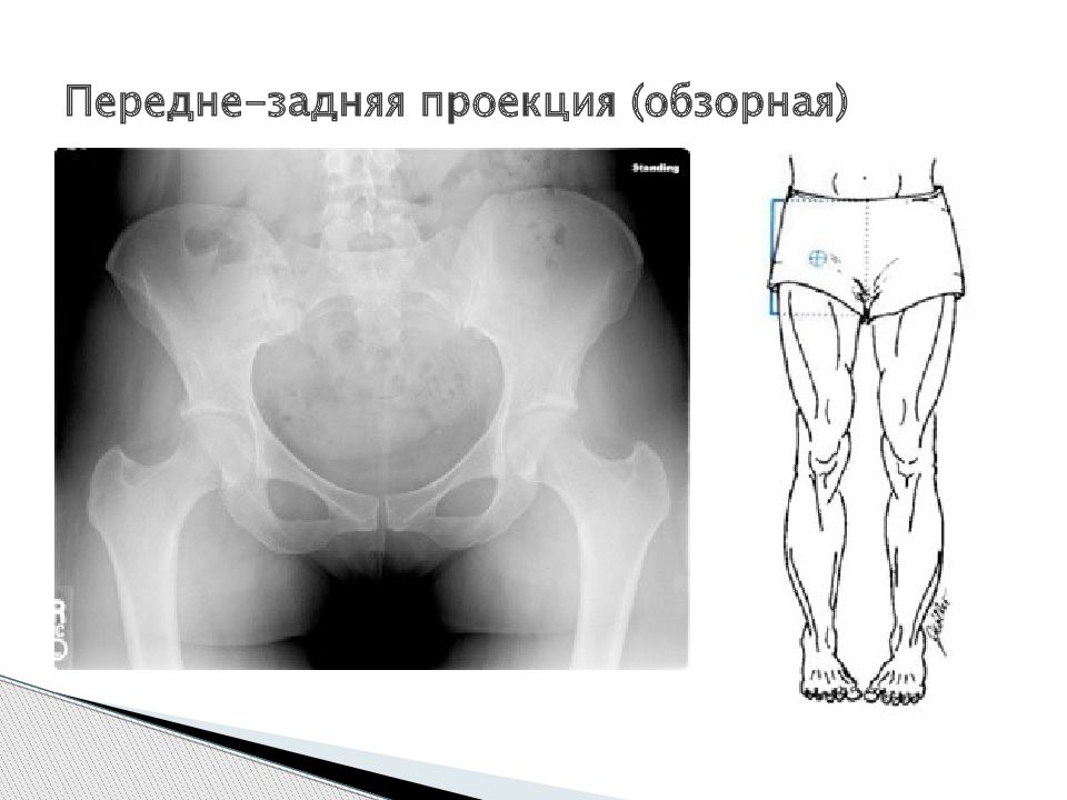 Суставы проекция. Передне задняя проекция рентген. Проекция тазобедренного сустава. Рентгеноанатомия тазобедренного сустава. Прямая проекция тазобедренного сустава.