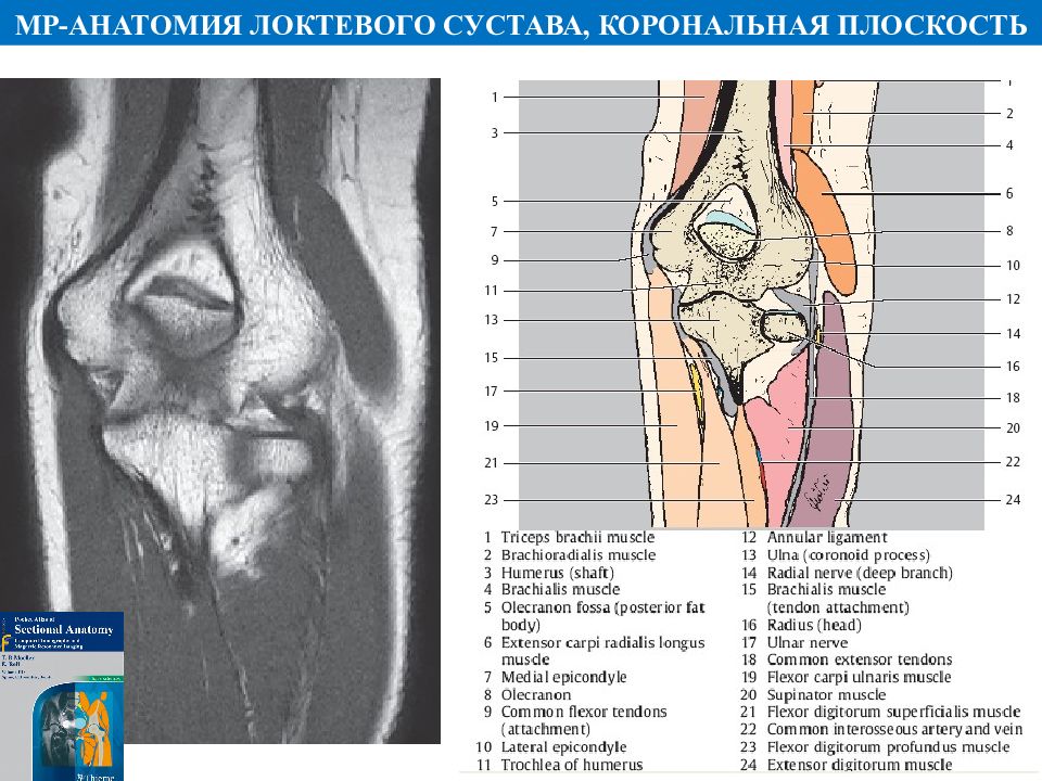 Мрт локтя. Анатомия локтевого сустава мрт. Сумки локтевого сустава анатомия мрт. Локтевой сустав строение мрт. Анатомия локтевой кости мрт.