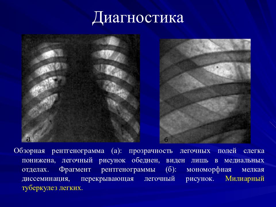 Легочный рисунок усилен в медиальных отделах