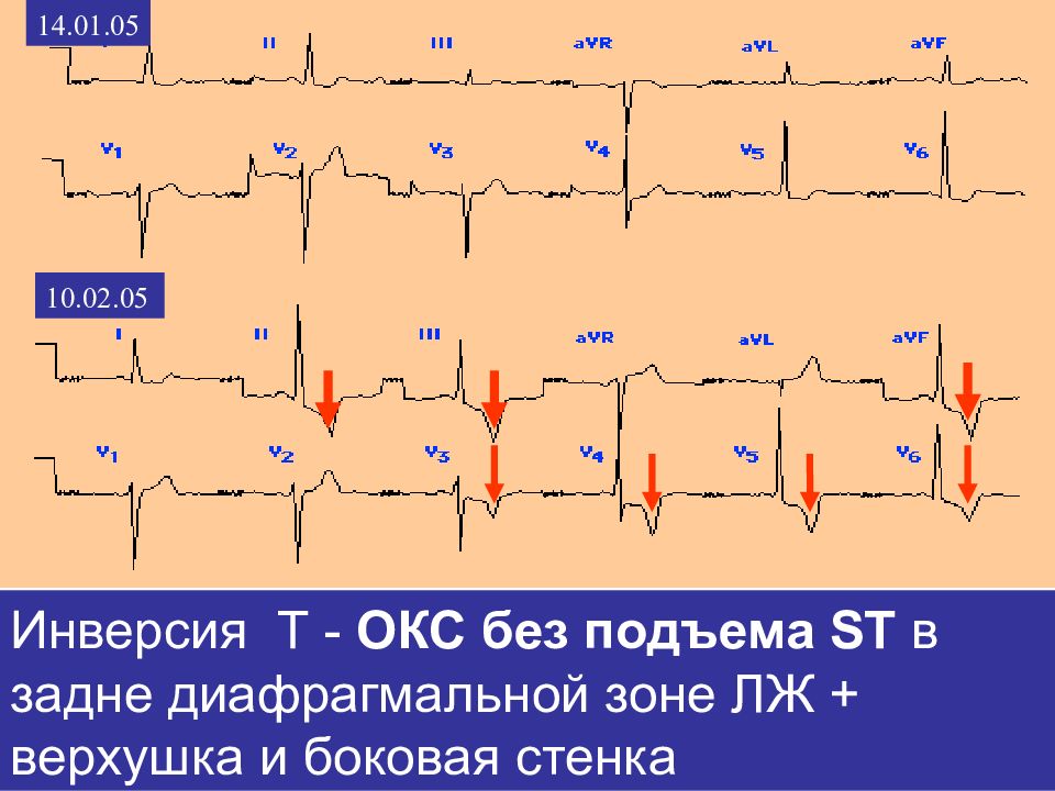Инфаркт миокарда без подъема сегмента st презентация