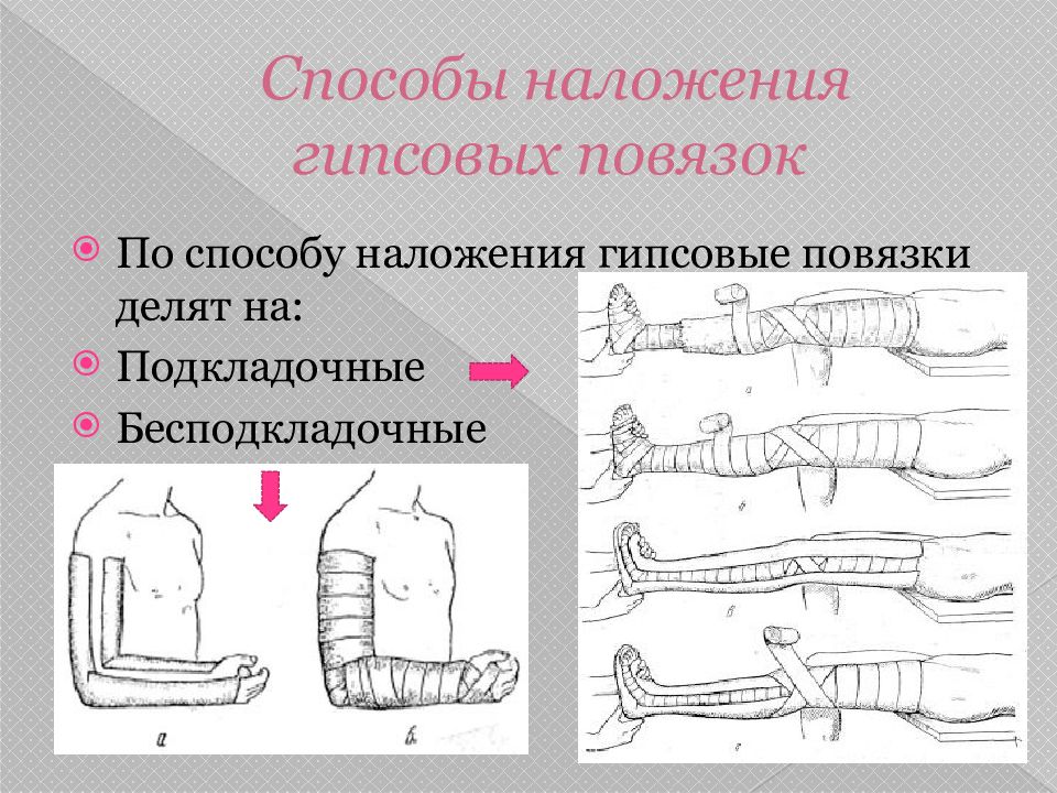 Гипсовые повязки презентация