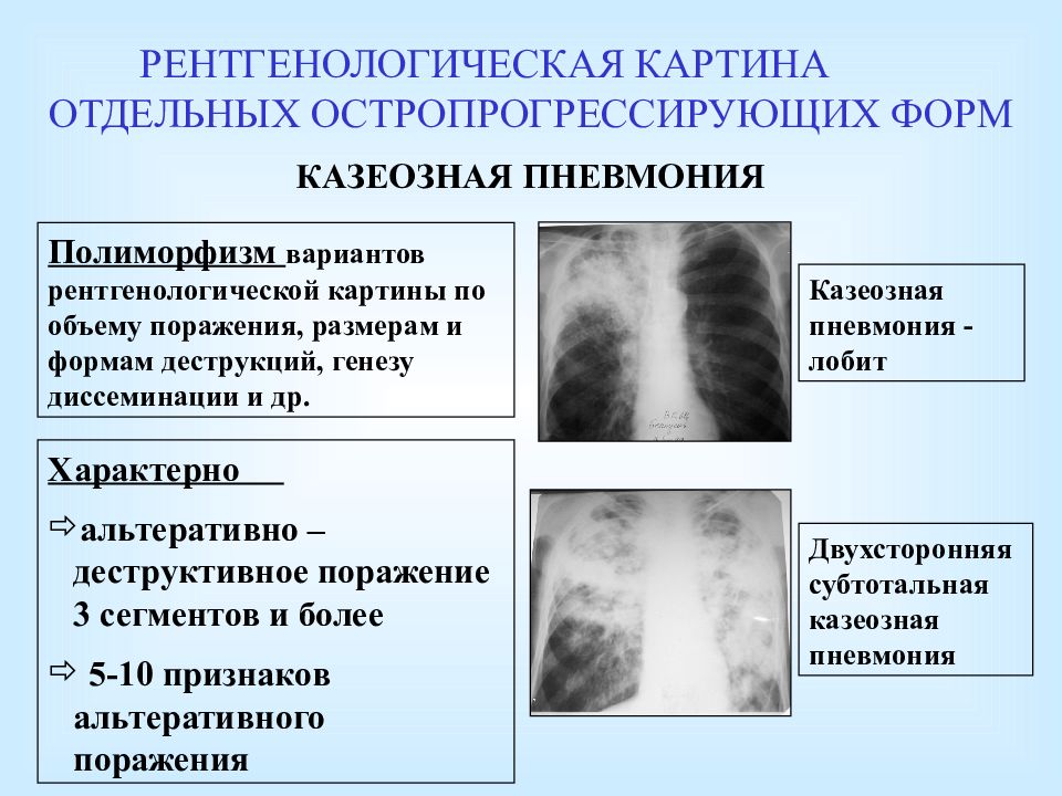 При какой форме рака легкого наблюдается картина быстротечного пневмонита