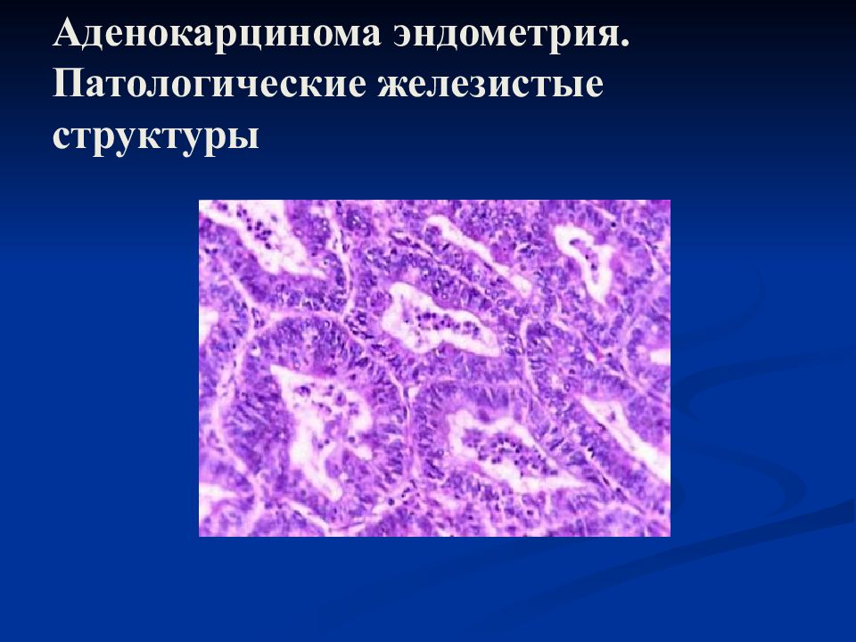 Аденокарцинома g1. Аденокарцинома эндометрия g1. Высокодифференцированная аденокарцинома эндометрия гистология. Эндометриоидная аденокарцинома эндометрия g1. Низкодифференцированная эндометриоидная аденокарцинома.