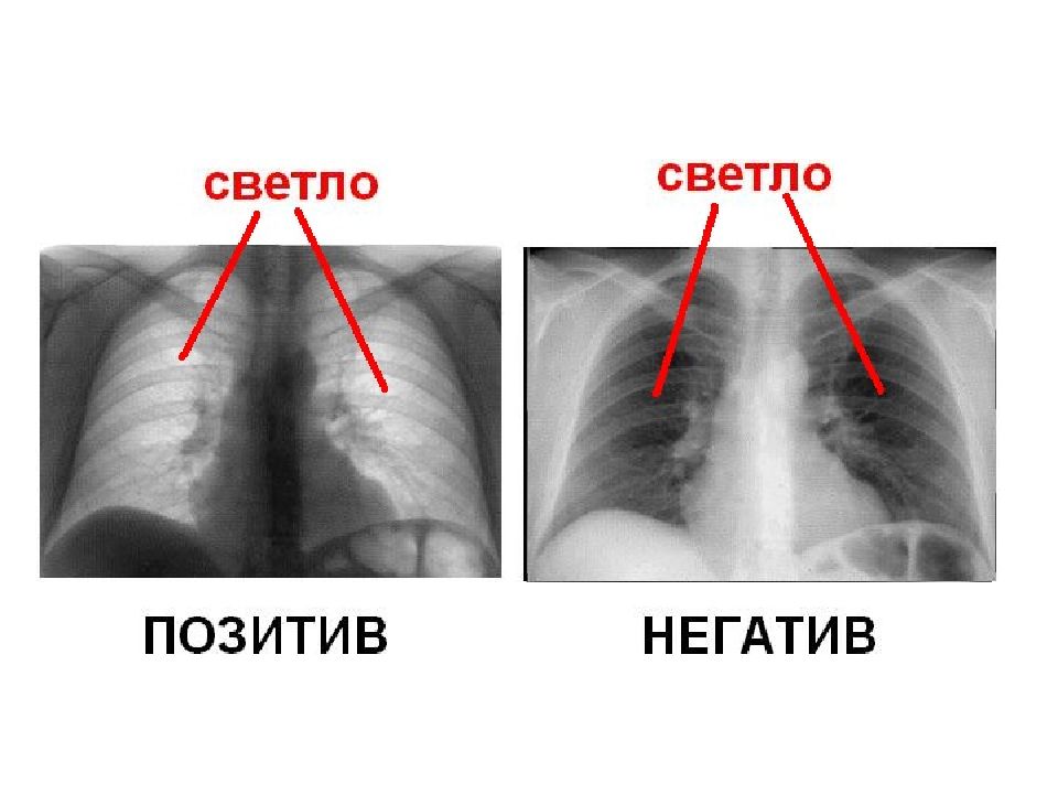 Негативное изображение рентген