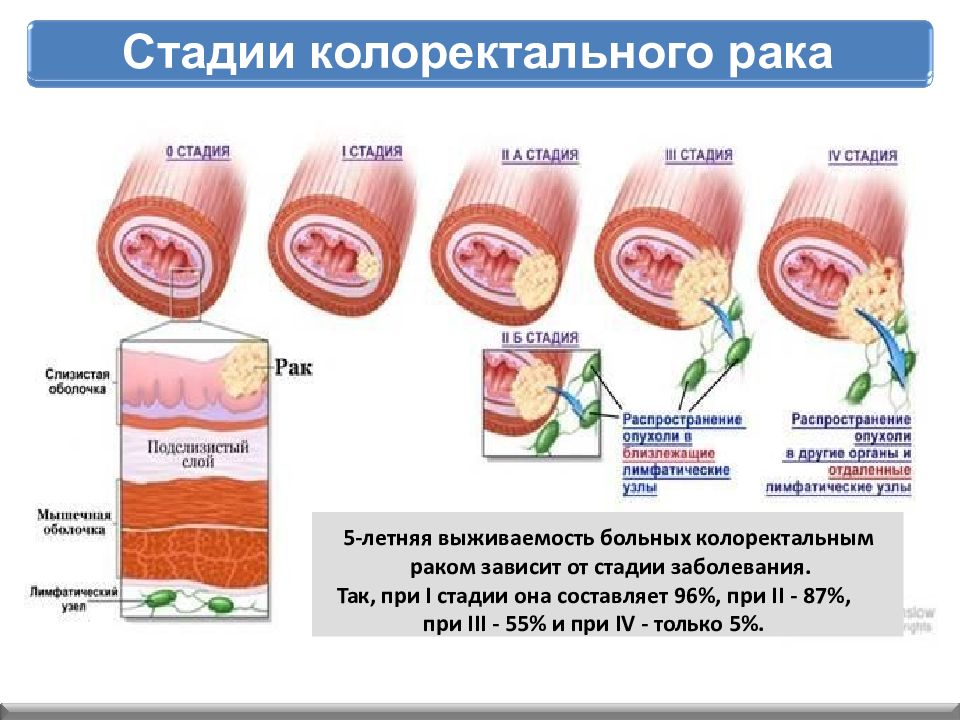 Колоректальный рак