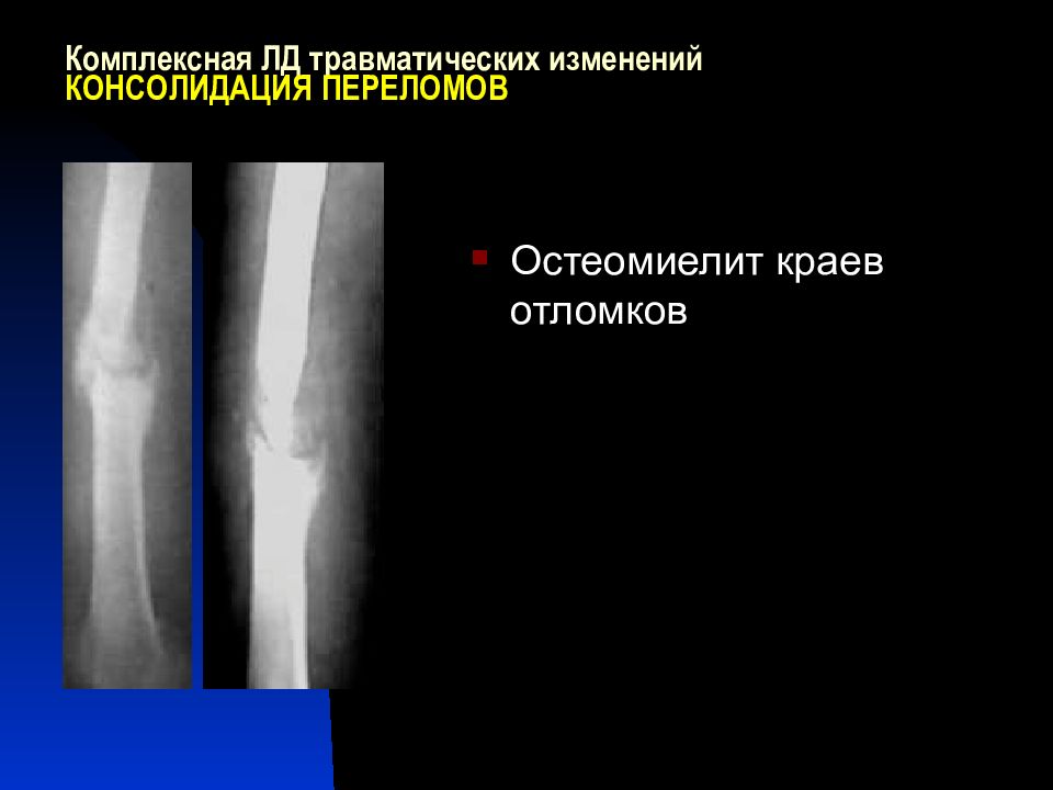 Консолидирующий перелом. Консолидация отломков. Консолидирующийся перелом рентген описание. Трамватическиеконсолидация. Консолидирующий перелом с удовлетворительным состоянием отломков.