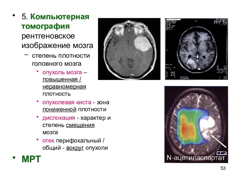 Опухоль мозга презентация