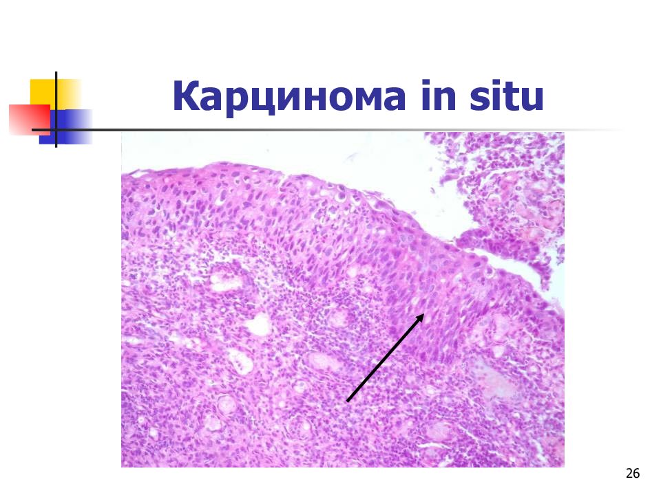 Плоскоклеточная карцинома in situ