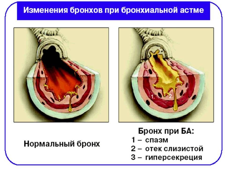 Проект бронхиальная астма